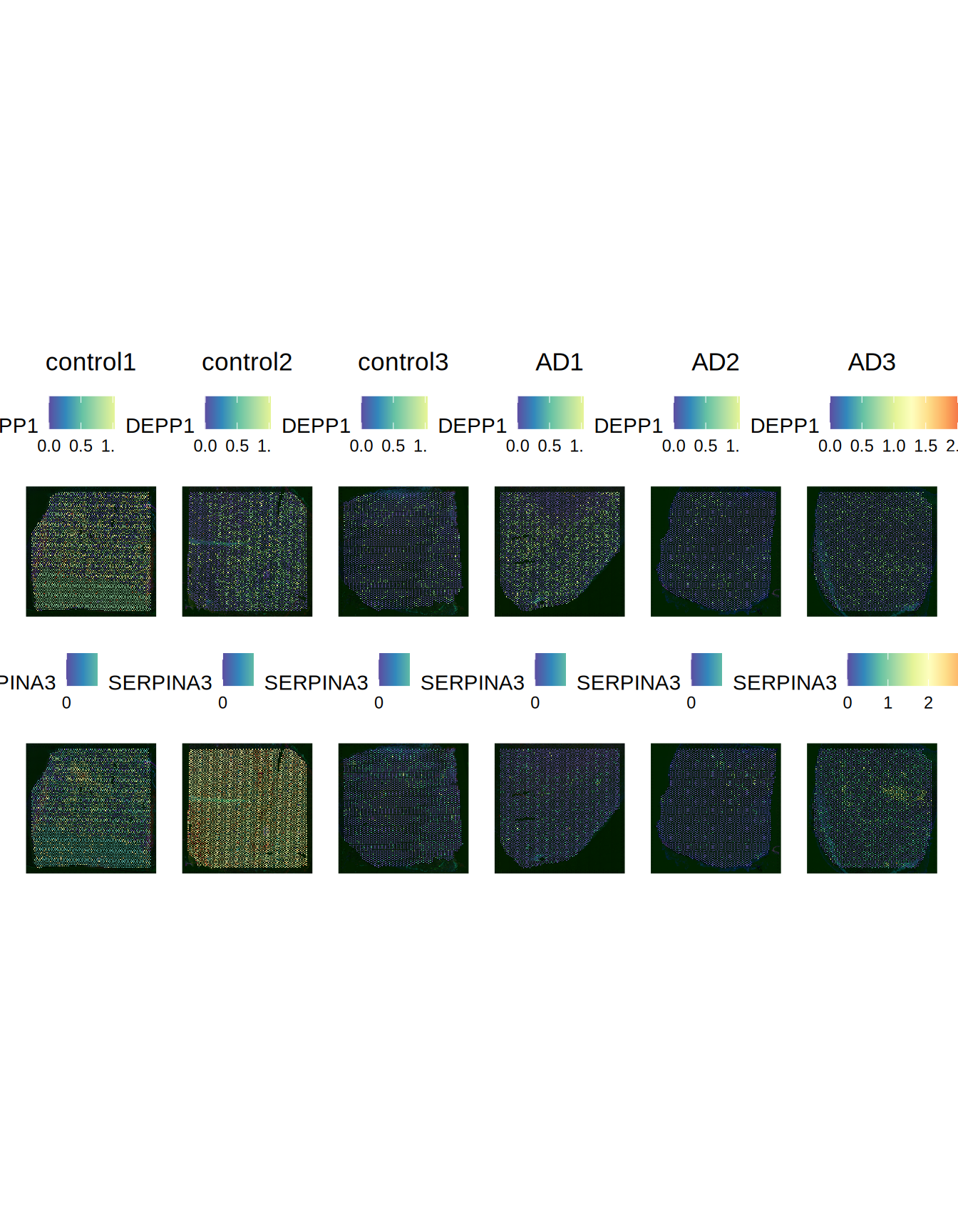 DEPP1 and SERPINA3 expression